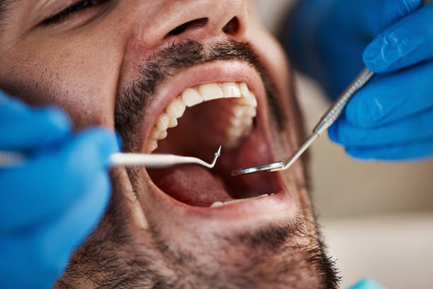 Best Emergency Treatment for Dental Infections or Abscesses in Richland, MS